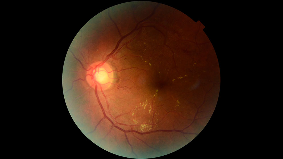 RETINAR 3